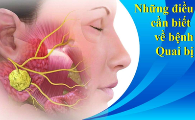Những điều cần biết về bệnh Quai bị